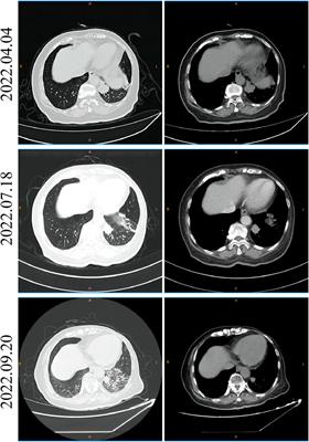 The diagnosis and treatment for a patient with cancer of unknown primary: A case report